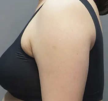 주름 보톡스 Before 이미지 주름 보톡스 Before 이미지