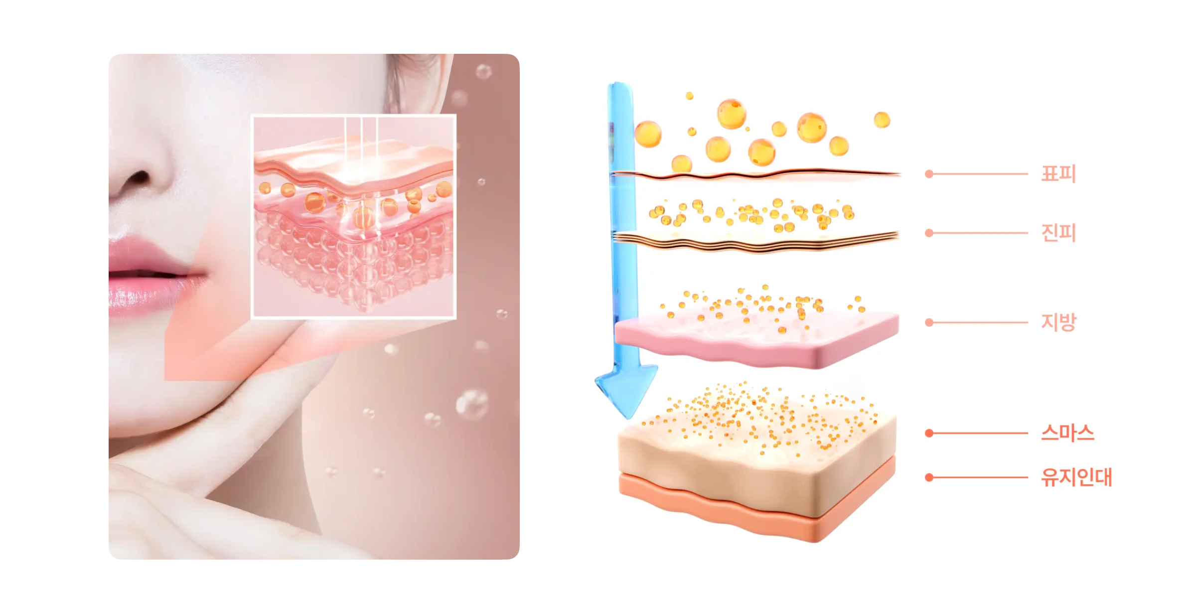 시술 설명 이미지 1