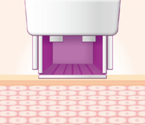 스킨 보톡스 시술 부위 설명 이미지 1