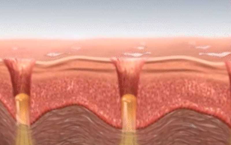스킨 보톡스 시술 부위 설명 이미지 2