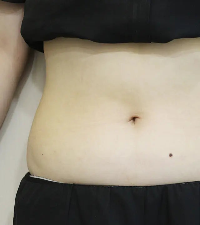 주름 보톡스 After 이미지