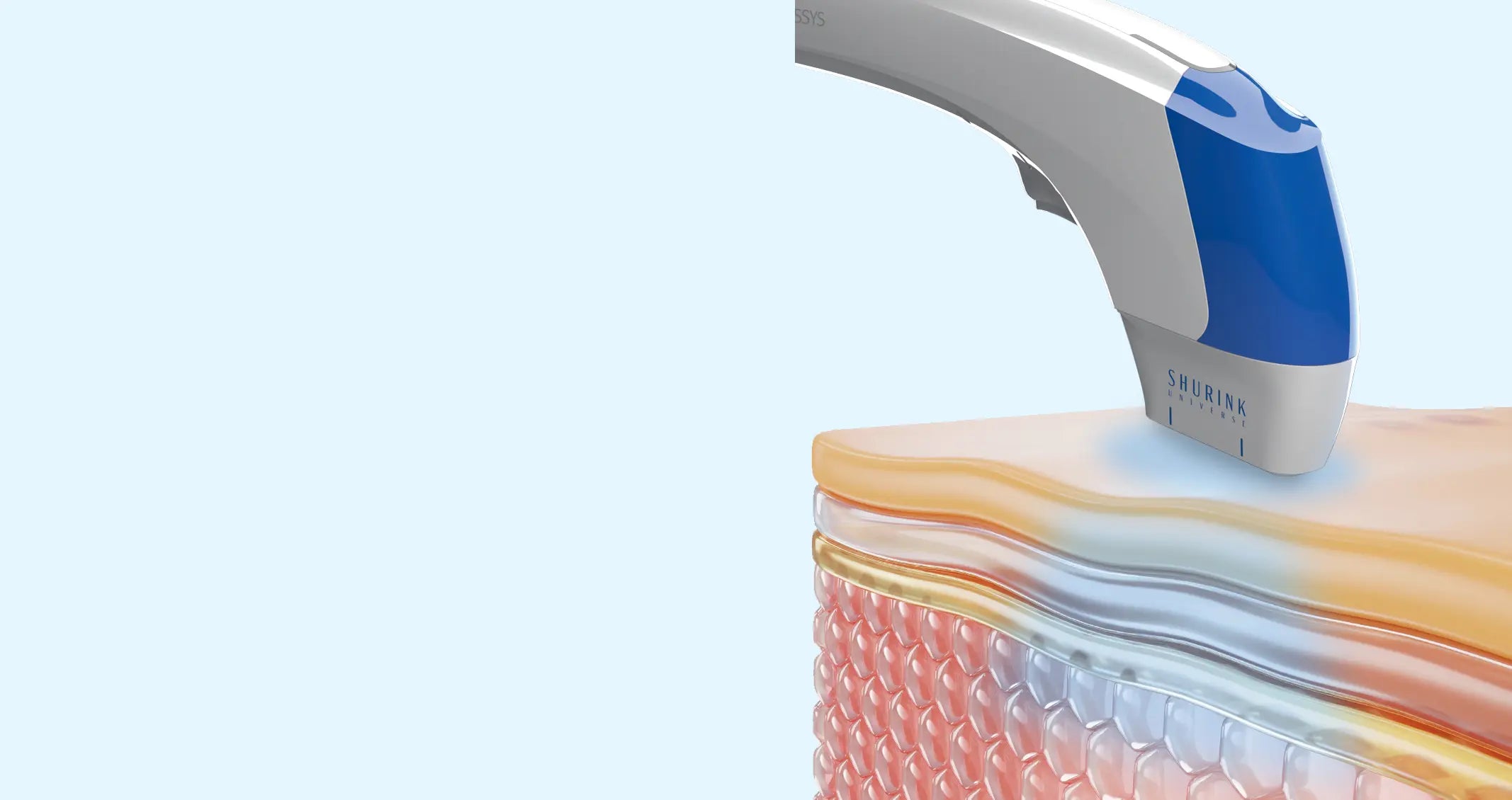 시술 장점 설명 이미지 1