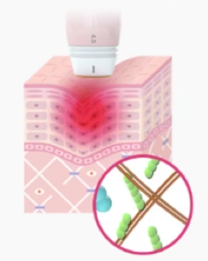 스킨 보톡스 시술 부위 설명 이미지 1