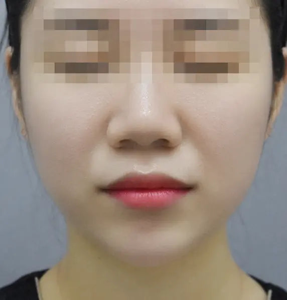 근육 보톡스 After 이미지