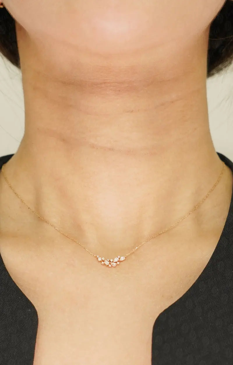 주름 보톡스 Before 이미지