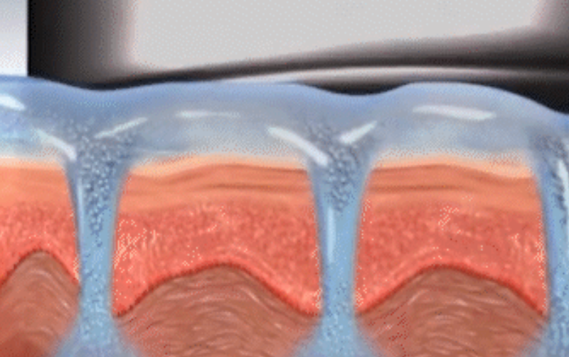 스킨 보톡스 시술 부위 설명 이미지 4