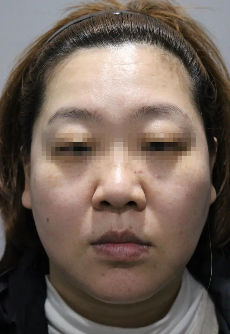 주름 보톡스 After 이미지