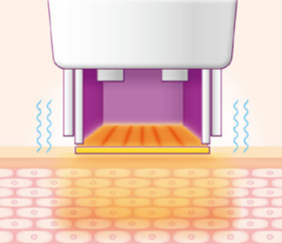 스킨 보톡스 시술 부위 설명 이미지 3