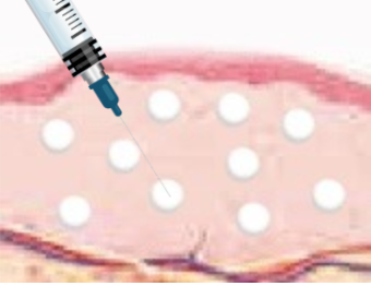 스킨 보톡스 시술 부위 설명 이미지 1