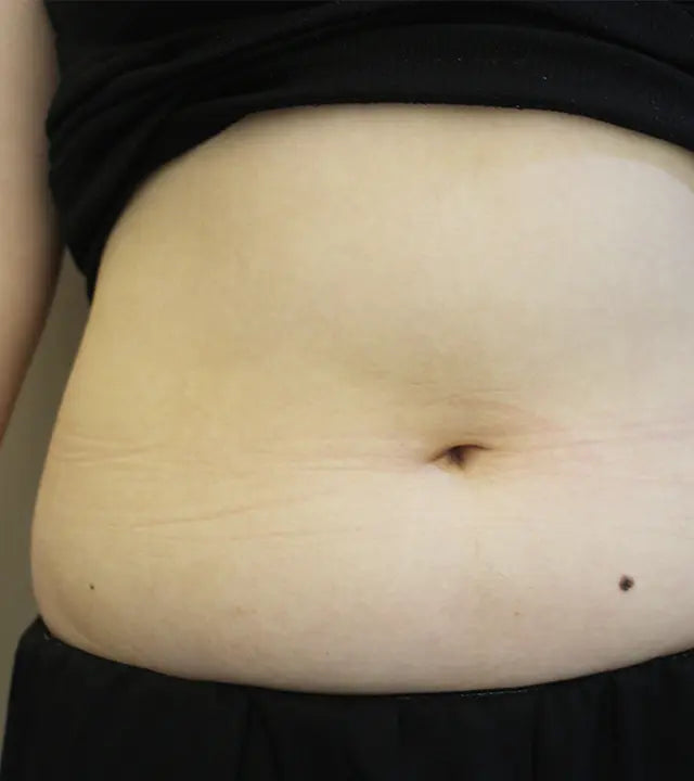 주름 보톡스 Before 이미지