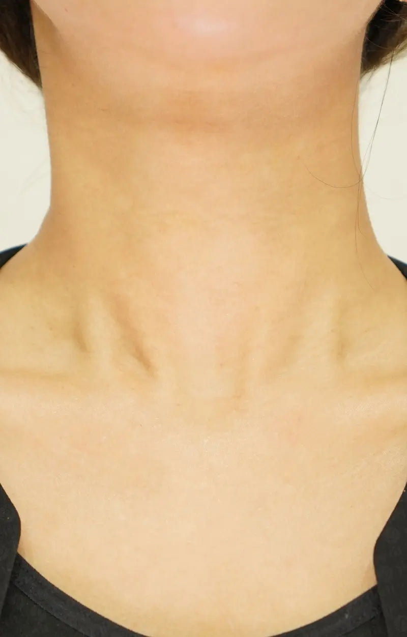 주름 보톡스 After 이미지