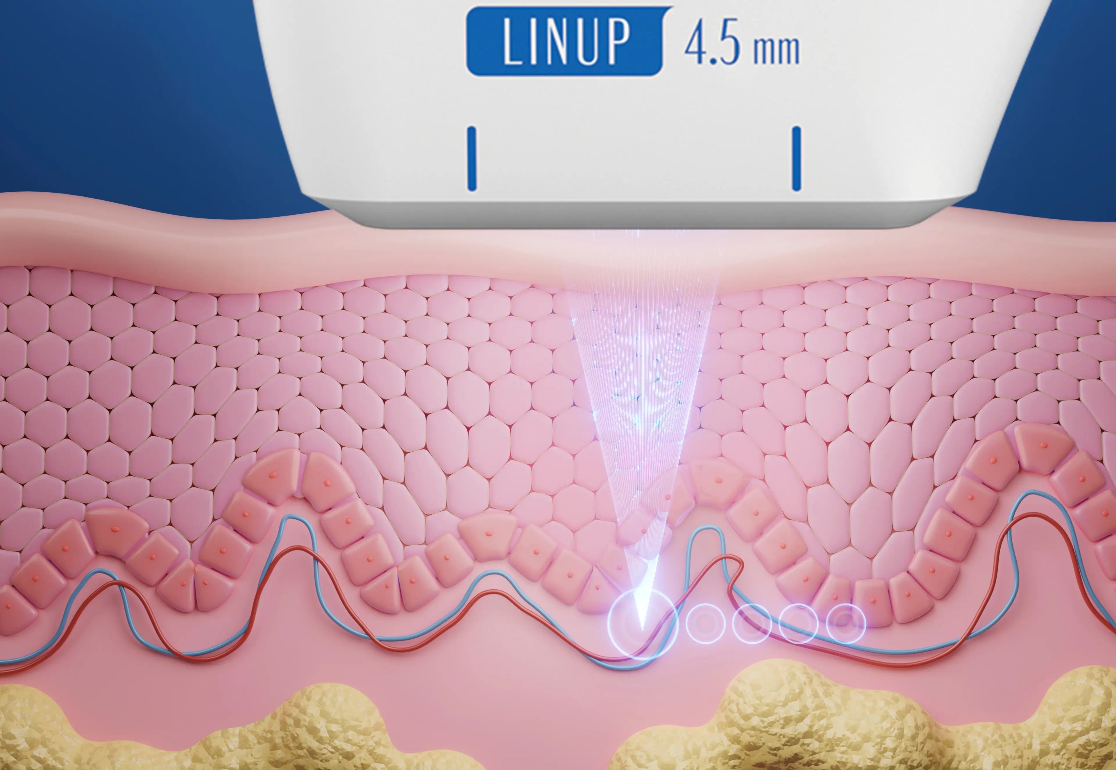 시술 장점 설명 이미지 1