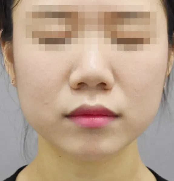 근육 보톡스 Before 이미지